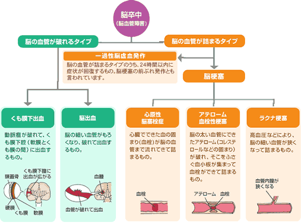 脳卒中 – 循環器内科.com